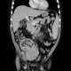 Liponecrotic lymph node, lymphoma: CT - Computed tomography